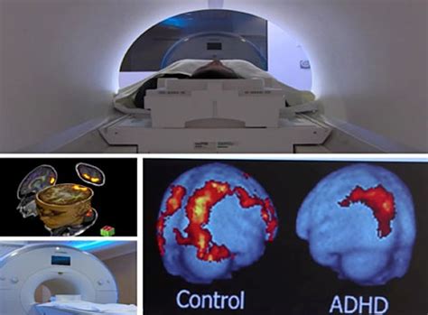 Brain Imaging Research Aims to Improve Outcomes for Children with Behavioral and Mental Health ...