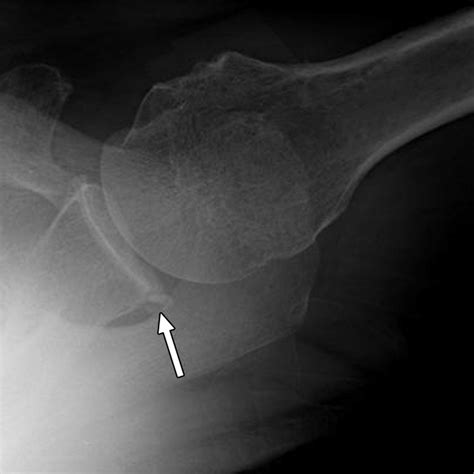 Imaging Signs of Posterior Glenohumeral Instability | AJR