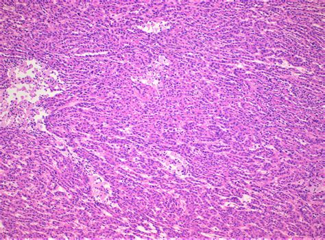 What Is Spindle Cell Carcinoma - Infoupdate.org