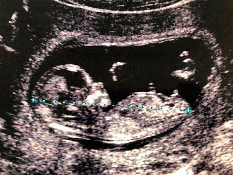 Ultrasound Machine vs Sonogram Machine - National Ultrasound