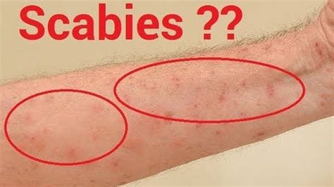 How To Know If You Have Scabies, And 7 Natural Treatments That Work Fast - YouTube