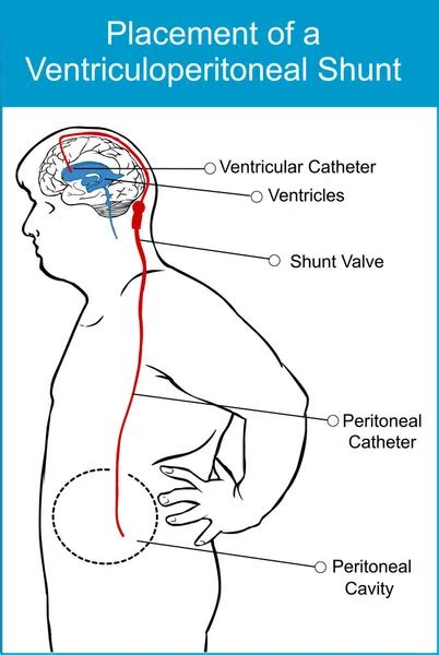 Lumbar Peritoneal Shunt Placement