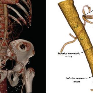 Computed tomography angiography showing occluded celiac trunk and the... | Download Scientific ...