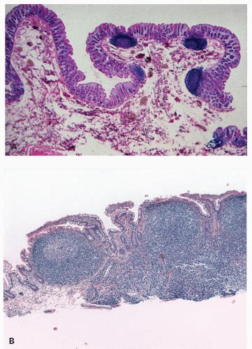 Immunodeficiency Disorders | Abdominal Key