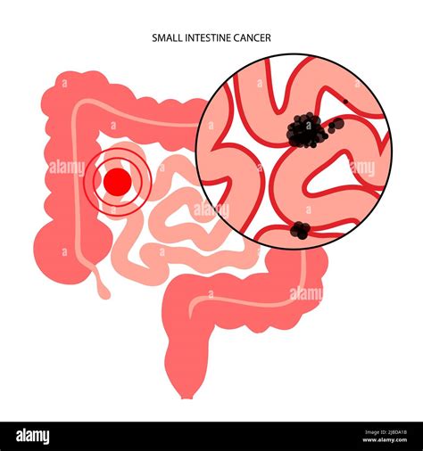 Small intestine cancer, illustration Stock Photo - Alamy