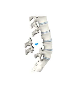 Lumbar Laminectomy Southfield | Spine Problem Treatment West Bloomfield ...