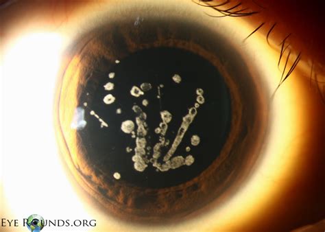 Granular corneal dystrophy