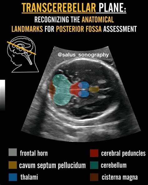 Neonate Brain | Diagnostic medical sonography, Ultrasound sonography, Obstetric ultrasound