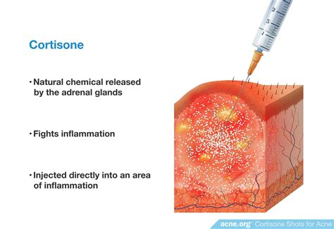 Cortisone Shots for Severe Acne - Nodules and Cysts - Acne.org