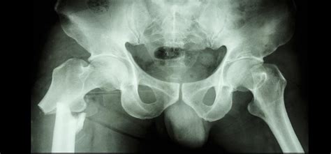 Osteoporotic hip fractures: Understanding your risk | News | University of Calgary