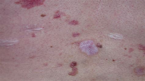 Skin Cancer Rash: Itchiness and Symptoms