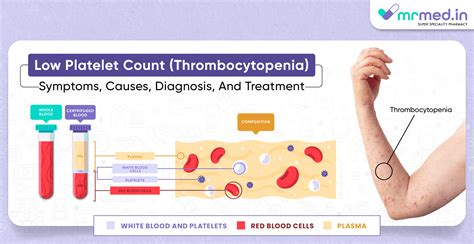 Low Platelet Count (Thrombocytopenia): Symptoms, Causes, Diagnosis, and Treatment | MrMed