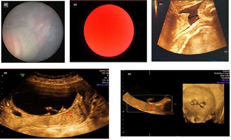 Evaluation of Fetoscopy Role in Fetal Surgery and Fetal Medicine