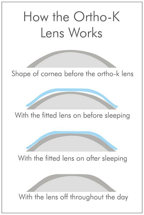 ORTHO-K - Orthokeratology