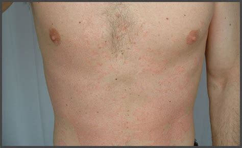 Early stages of psoriasis pictures | Psoriasis expert