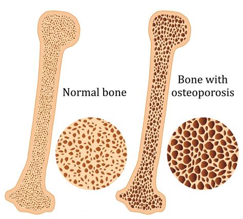 Osteoporosis - My Family Physio