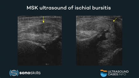 SonoSkills - Ischial bursitis is caused by prolonged...