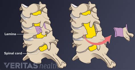 Posterior Cervical Laminectomy