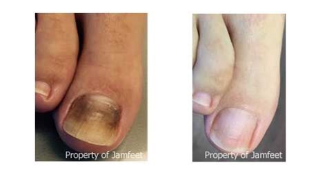 Before and After Toenail Photo | Tower Foot & Ankle