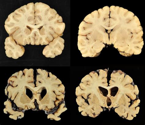 Images: Brains with CTE | Live Science