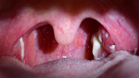 Because of Their Location Swollen Palatine Tonsils May Interfere With