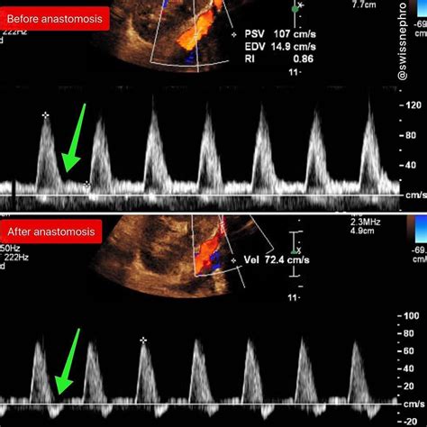 Doppler waveform of the iliac artery before and after transplant renal ...