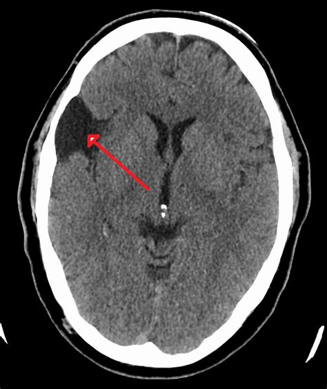 Arachnoid Cysts; Leptomeningeal Cysts; Arachnoid Diverticula