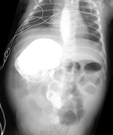 Intestinal Malrotation And Midgut Volvulus Image