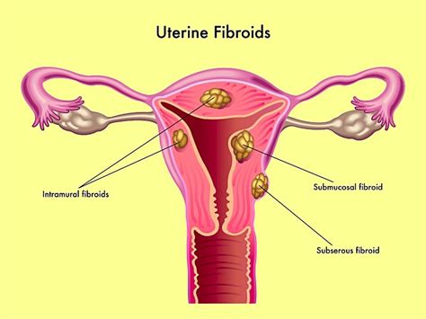 Testosterone Levels May Play Part in Uterine Fibroid Risk