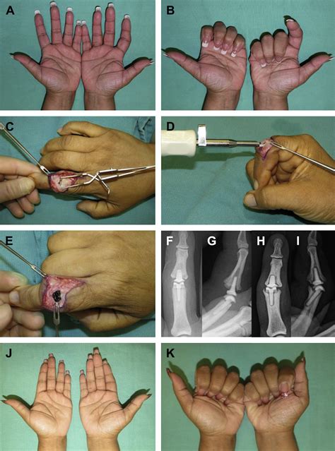 Implant Arthroplasty - Hand Clinics