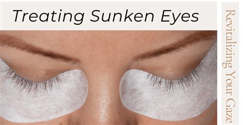 5 Rapid Remedies for Treating Sunken Eyes | Clinikally|