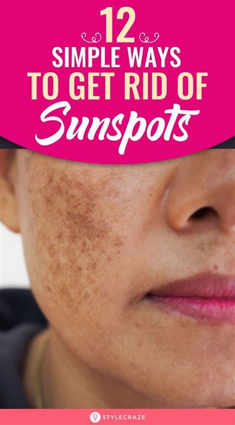 12 Simple Ways To Get Rid Of Sunspots in 2020 | Sun spots on skin, Sunspots, Sunspots on face