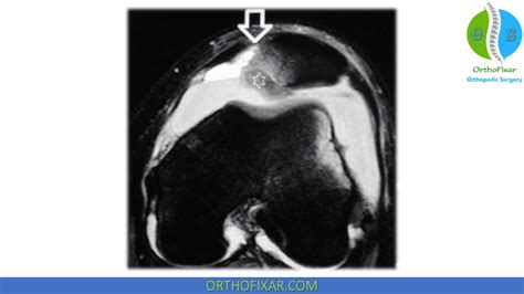 MPFL Reconstruction Surgery | OrthoFixar 2024