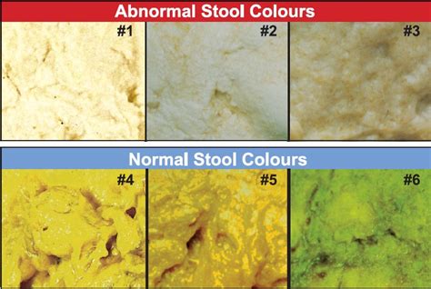 Adult Human Poop Chart Stool Color