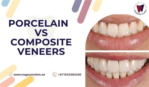 Porcelain Veneers vs Composite Veneers | Which One Best For You?