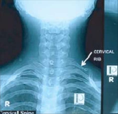 Plain X-ray showing the left sided cervical rib. | Download Scientific ...