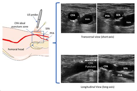 Schematic representation of ultrasound (US) survey required to localize... | Download Scientific ...