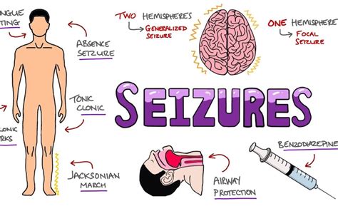 Types of Epilepsy & Seizure Disorders in Adults - EpilepsyU