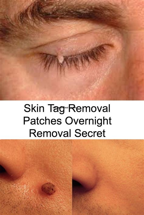 How Do You Remove A Skin Tag On Eyelid - HOWTORMEOV