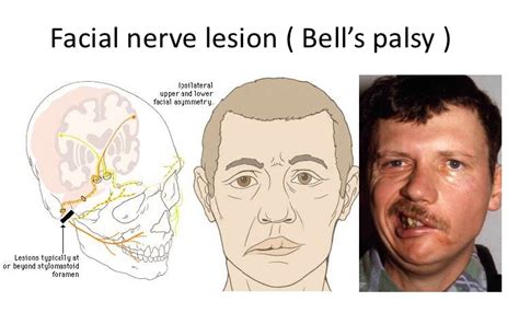 Bell's Palsy Causes, Symptoms, Diagnosis And Treatment - Natural Health News