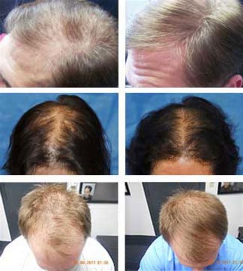 Laser Hair Therapy – Treatment for Hair Loss