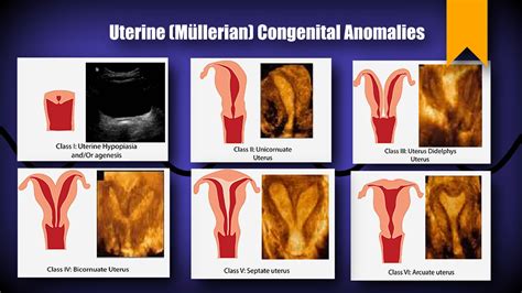 Uterine Anomaly Classification – Sonographic Tendencies