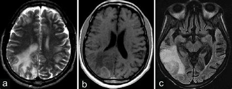 Brain MRI scans showing multiple hyperintense lesions on T2-weighted... | Download Scientific ...