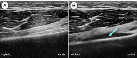 How I Do It: Genicular Nerve Blocks for Acute Pain (2022)