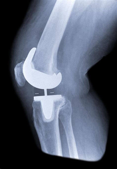 Knee Replacement | Knee Arthroplasty | MedlinePlus