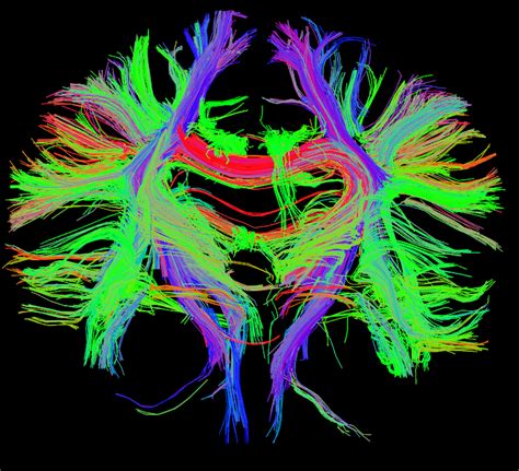 Diffusion Tensor Imaging.