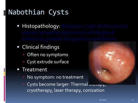 Nabothian cyst - Pictures