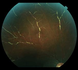 10 Retinal Vasculitis | Ento Key