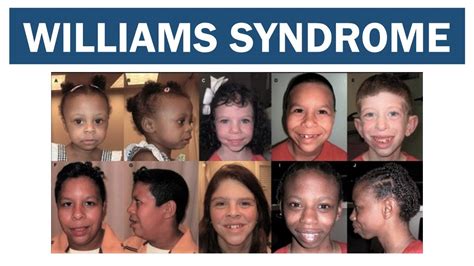 Williams Syndrome | Williams–Beuren syndrome - YouTube