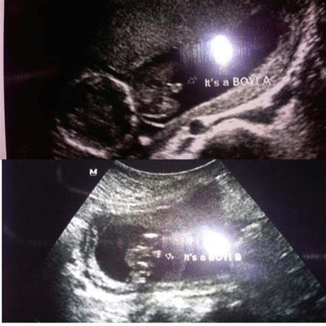 Twins Gender Ultrasound (pics) - BabyCenter